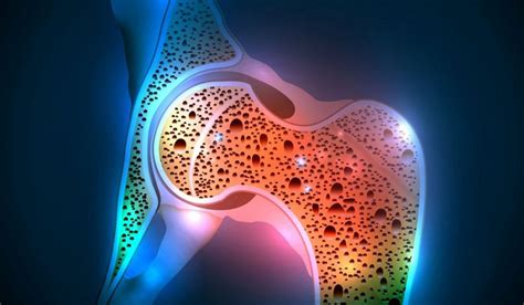 Osteoporoz Nedenleri ve Önleme Yolları