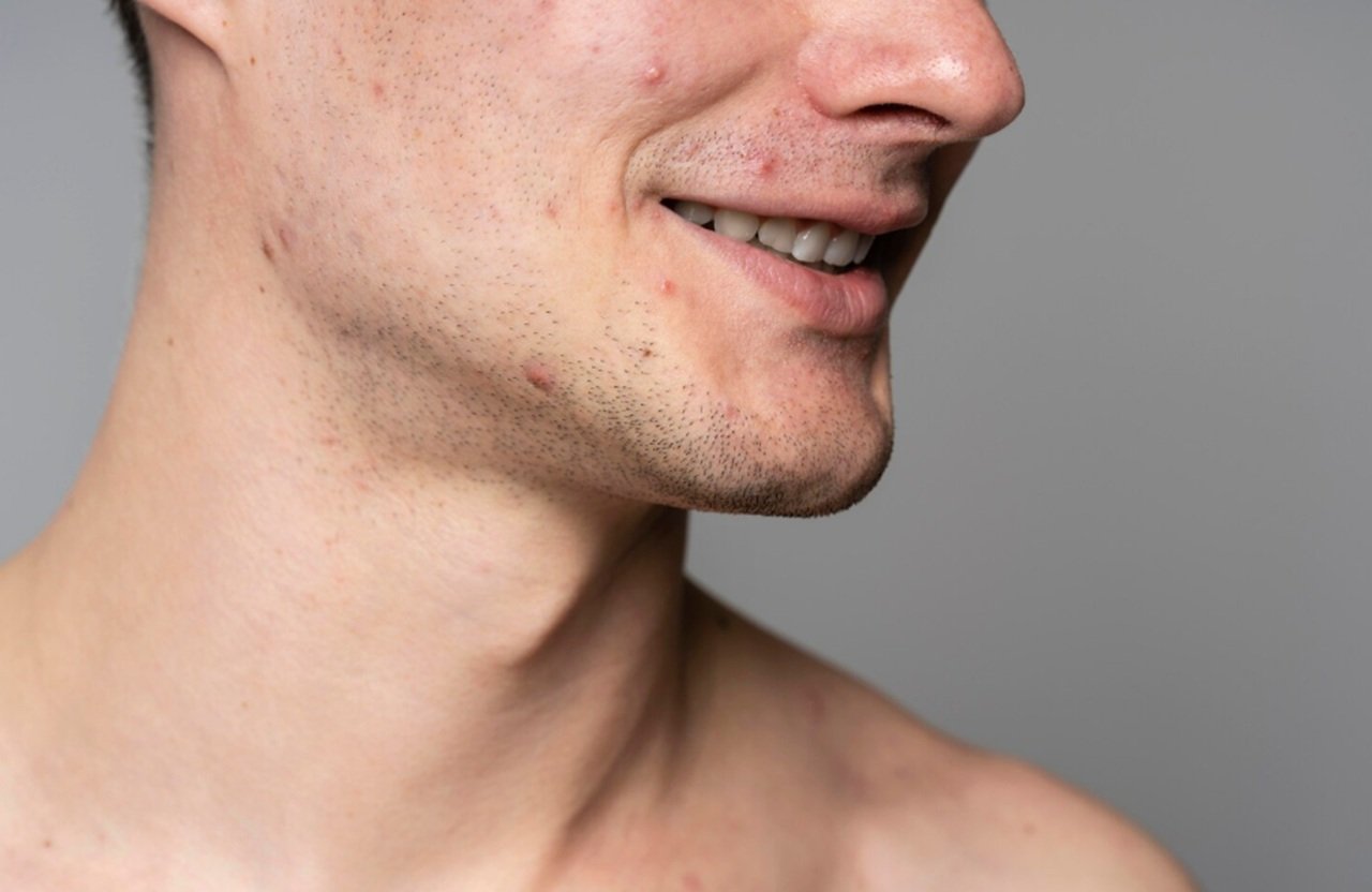 Akne Eğilimli Ciltlerde Leke ve Yaşlanma Karşıtı Bakım 2 akne-egilimli-ciltlerde-leke-ve-yaslanma-karsiti-bakim